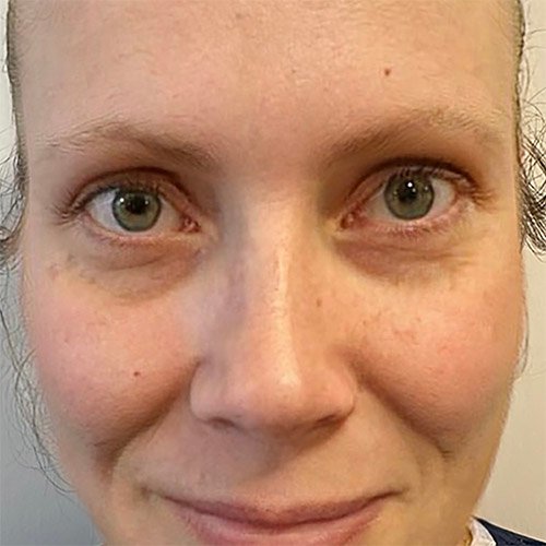 Eyebrow Transplant Before Image 8